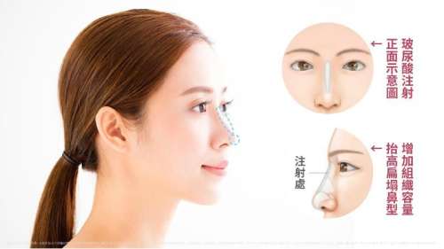 玻尿酸隆鼻的危害有哪些?先看看这几点再决定也不迟