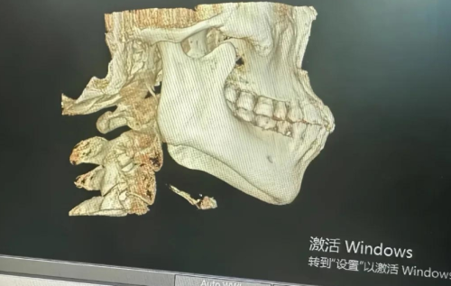 正颌手术的害处有哪些?需要注意什么