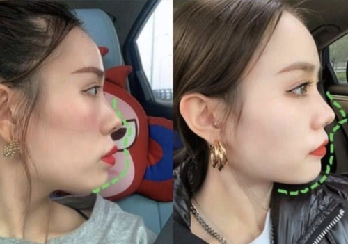 面中凹陷怎么矫正?今天就来聊聊怎么把这块“凹陷”给“填”起来!