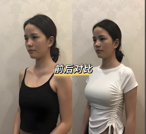 北京地坛医院隆胸多少钱？美丽蜕变需要理性决策与科学规划