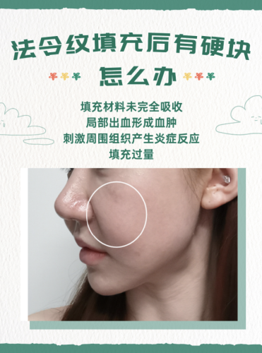 玻尿酸填充法令纹有硬块多久能消除？ 以下是不同原因导致的硬块消除时间