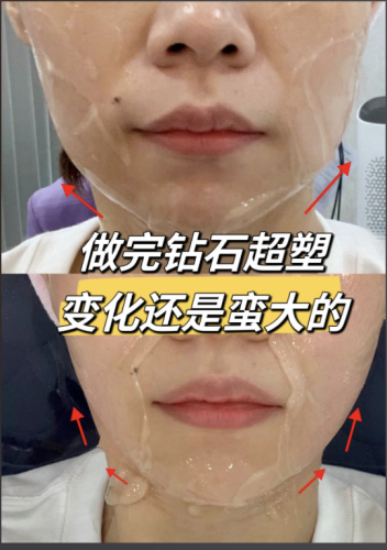 钻石超塑和热拉提哪个会更好?一文带你看透差异,轻松做出科学选择!