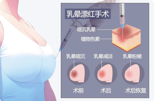 乳头飘红大概多少钱?建议多咨询几家机构,谨慎对待才能更放心