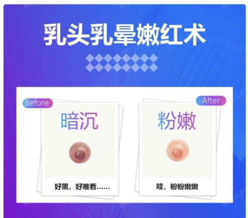 乳头飘红手术费用：价格上下浮动，简直像开盲盒