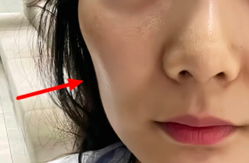 面部凹陷填充能维持多久？揭秘影响时长的关键因素