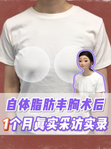 自体脂肪丰胸恢复期是多久？搞清楚这个心里就有底了