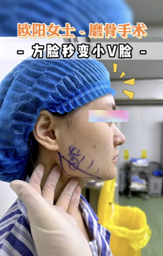 磨下颌角效果好吗？让面部更和谐对称，提升整体美感