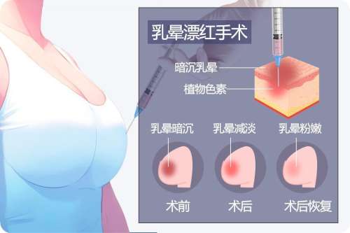 乳头飘红要打麻药嘛，影响痛感的3个关键因素你必须知道
