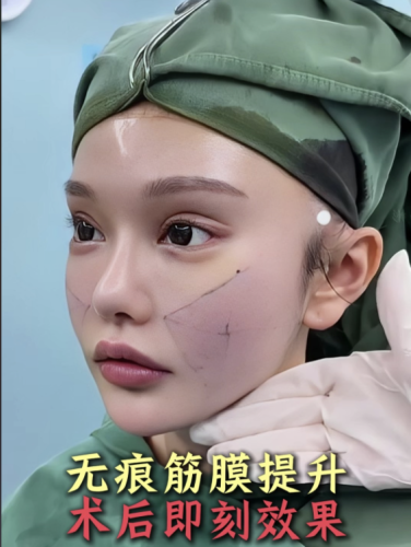 做筋膜提升术多少钱？好好唠唠这手术的收费门道