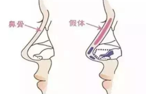 临沂中心医院隆鼻价格,费用透明公开