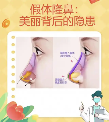 假体隆鼻的危害和后遗症，一定要提前了解！