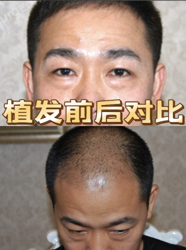 甘肃省人民医院植发多少钱?看完直接拿捏预算!