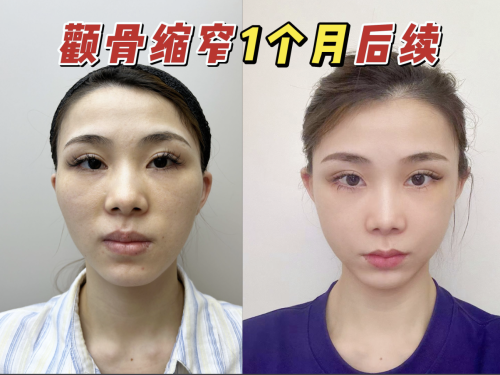 颧骨突出做手术多少钱?手术价格表帮你算清变美账!