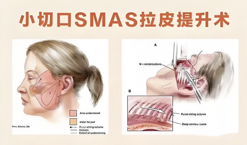 smas除皱术和拉皮:抗衰界的 “绝代双骄”,到底该 pick 谁?