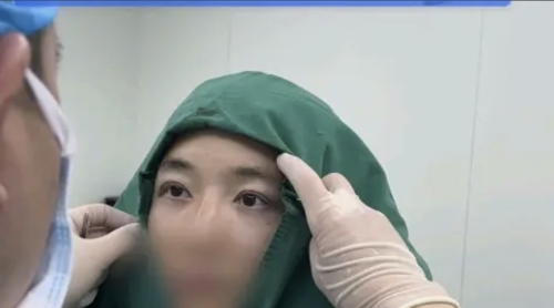 王金明医生修复双眼皮怎么样？肉条眼秒变无辜狗狗眼