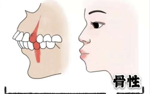 骨性嘴凸怎么矫正?从“凸嘴星人”到“侧颜杀”的108种可能