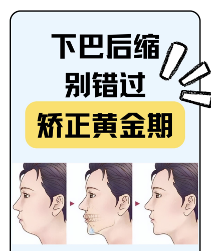 下巴后缩怎么造成的？12-16岁趁早揪出这 5 大 “幕后黑手”！
