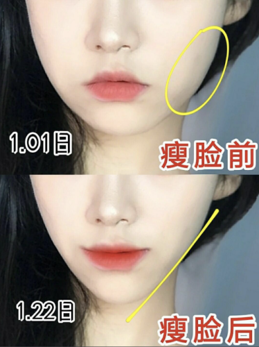 黑龙江艺星整形瘦脸怎么样？闺蜜做完我惊了 —— 脸小了一圈，还像没动过！