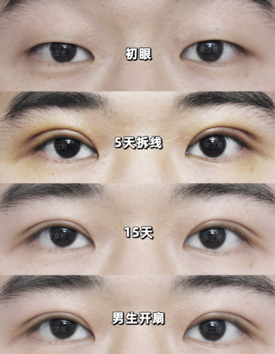 付冰川医生和田霞医生哪个做双眼皮好?各有千秋,眼睛像 “开了自然滤镜”,宽度误差不超过 0.5mm。
