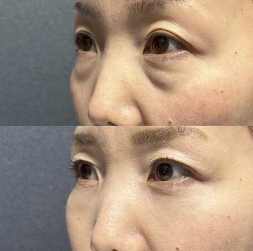 哈尔滨超龙和瑞丽哪家外切眼袋做得好？眼袋退退退，选对医院真的会谢！