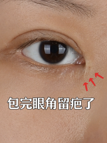 做内眼角会留疤吗?3个关键因素+3个真人案例,附避疤指南