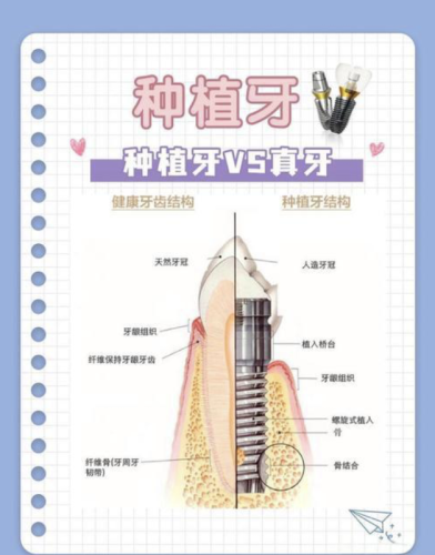 北京中诺口腔医院种牙怎么样？实测三级专科+99.2%存活率，这3类人选超划算
