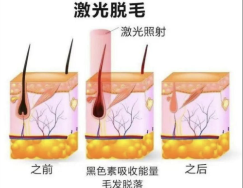 激光脱毛原理大揭秘！为什么有的人脱一次就干净？内附案例+表格