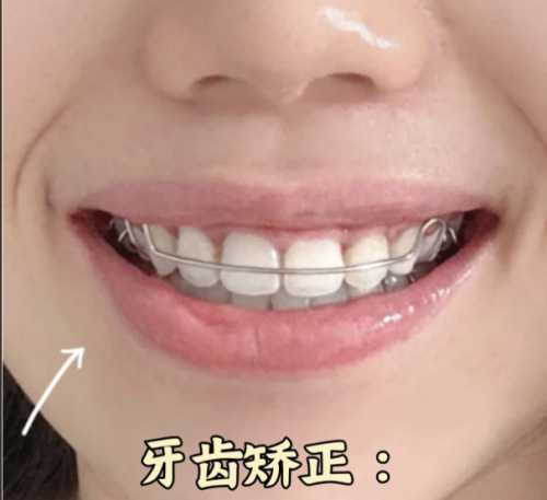 泉州柏德口腔矫正牙齿怎么样？真实案例+2025价格表揭秘