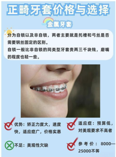 北京中诺牙套价格表：技术同源+耗材透明，不玩猫腻