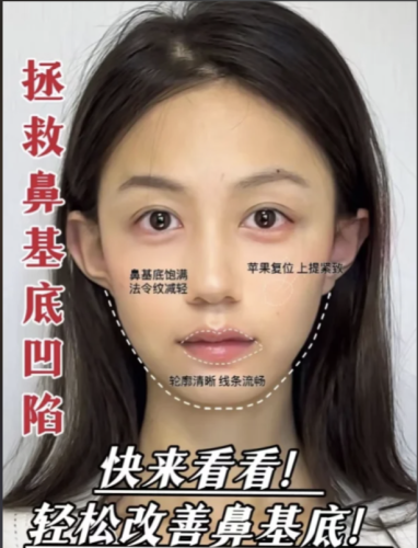 艾维岚填充鼻基底好不好？3个真实案例+2份数据表，揭秘抗衰填充新选择