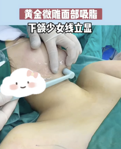 下巴黄金微雕恢复过程:7天消肿、1个月自然?真实案例+时间表给你答案