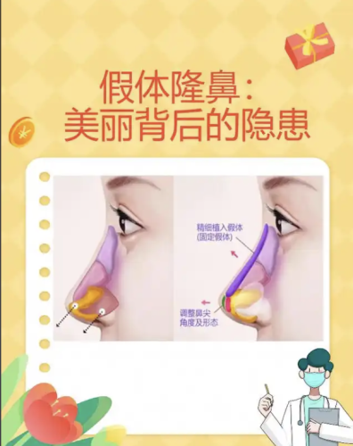 微晶瓷隆鼻怎么取出？3个真实案例+2份数据表，揭秘安全取出全流程