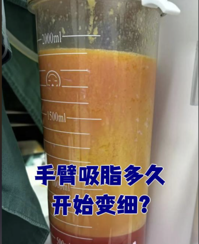 手臂吸脂多久开始变细?3类吸脂方式实测:术后7天显轮廓,3个月达最佳效果