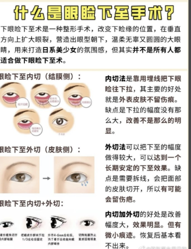 做眼角下至的手术作用:真能放大双眼?3大核心作用+2类适配人群实测