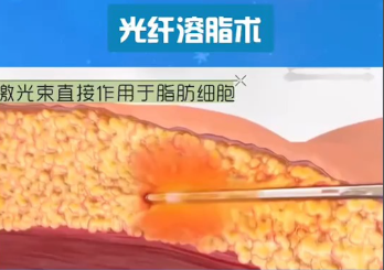 射频溶脂和光纤溶脂区别:溶脂不是 “一刀切”,选错方式可能白花钱还留疤