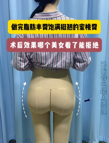 脂肪丰胸和丰臀一起做可以吗?2024实测真相:安全吗、恢复多久、谁适合
