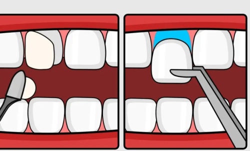 青岛美维乐牙齿贴面价格,做之前这些费用问题先搞清楚
