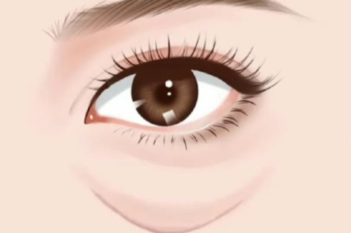 眼窝凹陷自体脂肪填充多少钱？手术流程＋复填概率一并了解