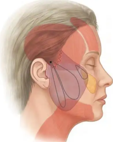 静态悬吊术和拉皮手术区别,适合人群、恢复时间和费用差距一次说清楚