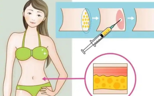 抽脂填充有什么危害？术前必须了解的潜在危害和适应证