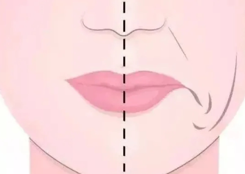 做口角囊袋提升术多少钱？手术费用和术后护理成本别忽略