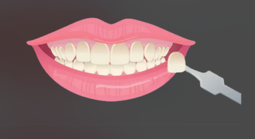 常德美奥牙齿贴面多少钱？材料种类、颗数不同价位参考