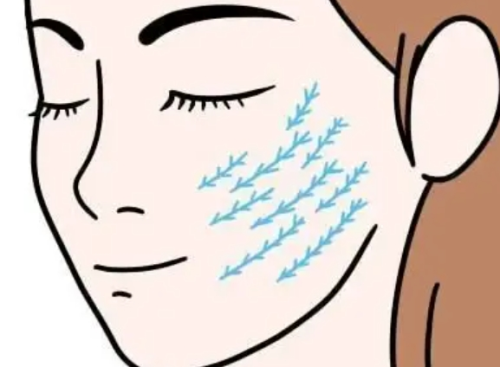 smas精准提升能管多久？和普通拉皮、线雕的效果时长对比