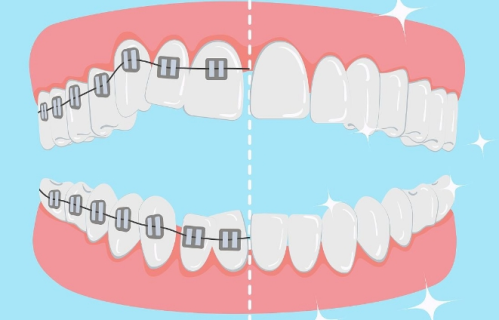 成都口腔医院牙套多少钱?从牙套类型到总费用一文搞定